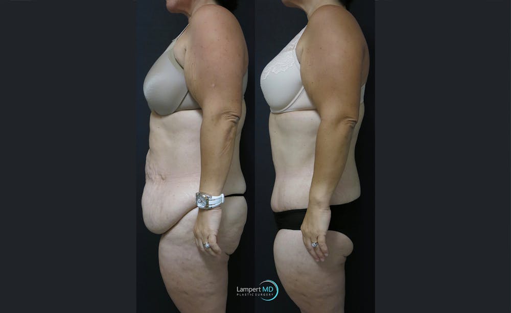 Tummy Tuck Before & After Gallery - Patient 122909145 - Image 4