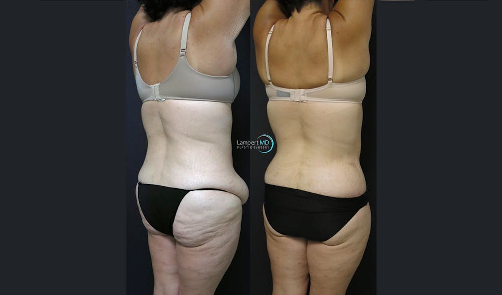 Tummy Tuck Before & After Gallery - Patient 122909145 - Image 5