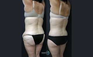 Tummy Tuck Before & After Gallery - Patient 122909145 - Image 6