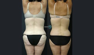 Tummy Tuck Before & After Gallery - Patient 122909145 - Image 7