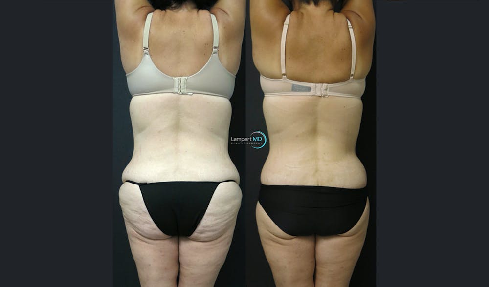 Tummy Tuck Before & After Gallery - Patient 122909145 - Image 7