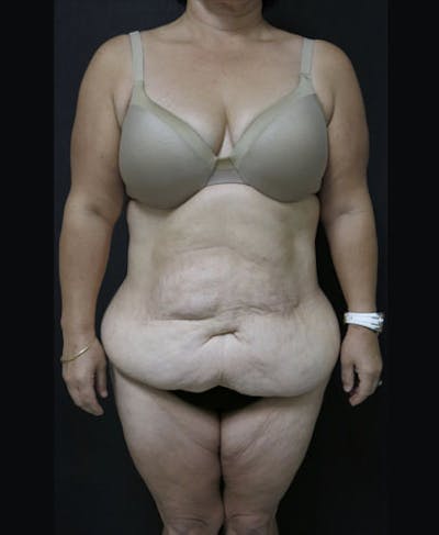Fat Grafting Before & After Gallery - Patient 122909151 - Image 1