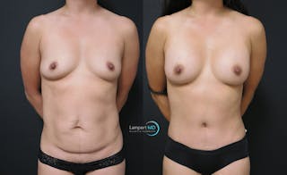 Tummy Tuck Before & After Gallery - Patient 122909148 - Image 1