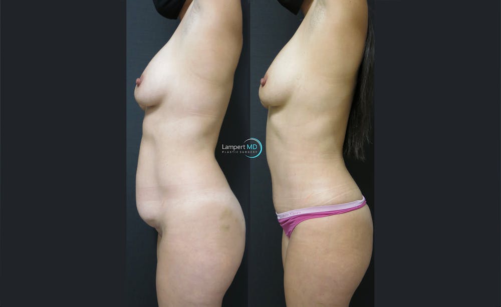 Tummy Tuck Before & After Gallery - Patient 122909147 - Image 3