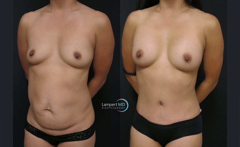 Tummy Tuck Before & After Gallery - Patient 122909148 - Image 2