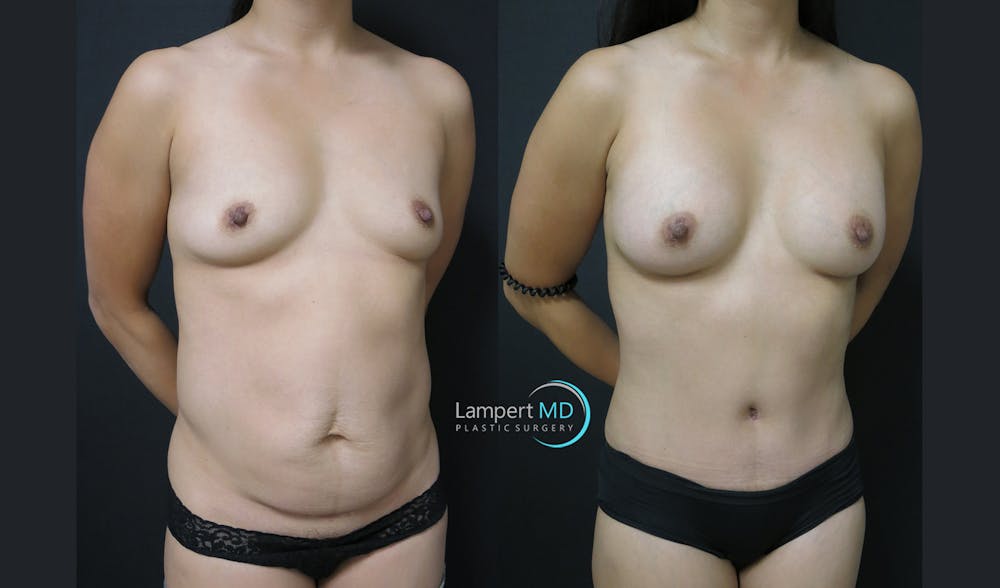 Tummy Tuck Before & After Gallery - Patient 122909148 - Image 3