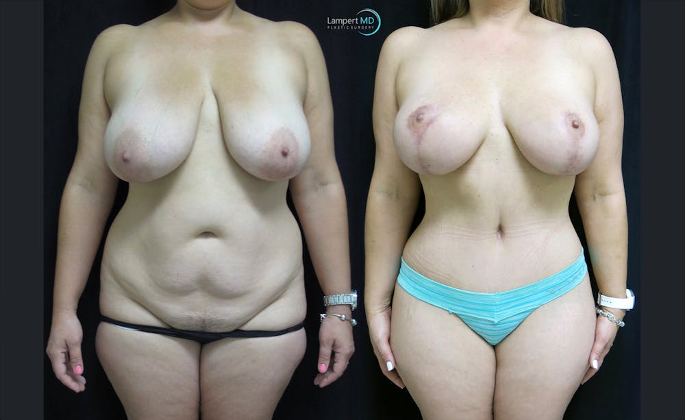 Tummy Tuck Before & After Gallery - Patient 122909150 - Image 1