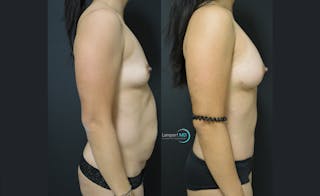 Tummy Tuck Before & After Gallery - Patient 122909148 - Image 4