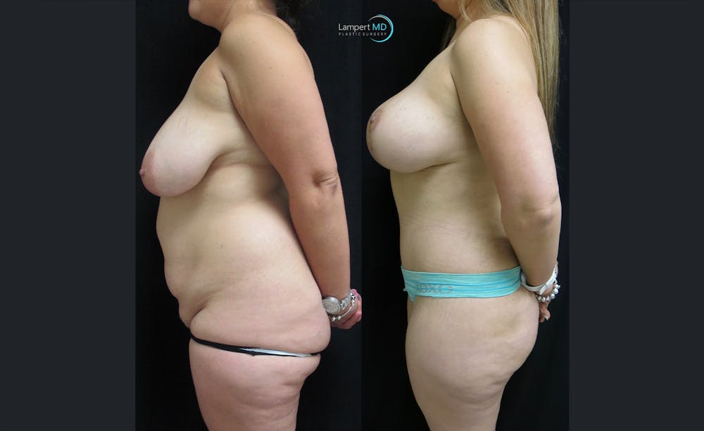 Tummy Tuck Before & After Gallery - Patient 122909150 - Image 3