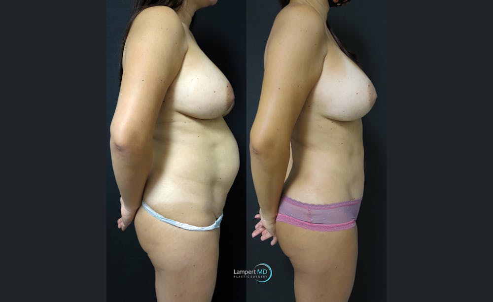 Tummy Tuck Before & After Gallery - Patient 122909158 - Image 3