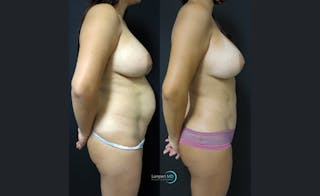 Tummy Tuck Before & After Gallery - Patient 122909158 - Image 3