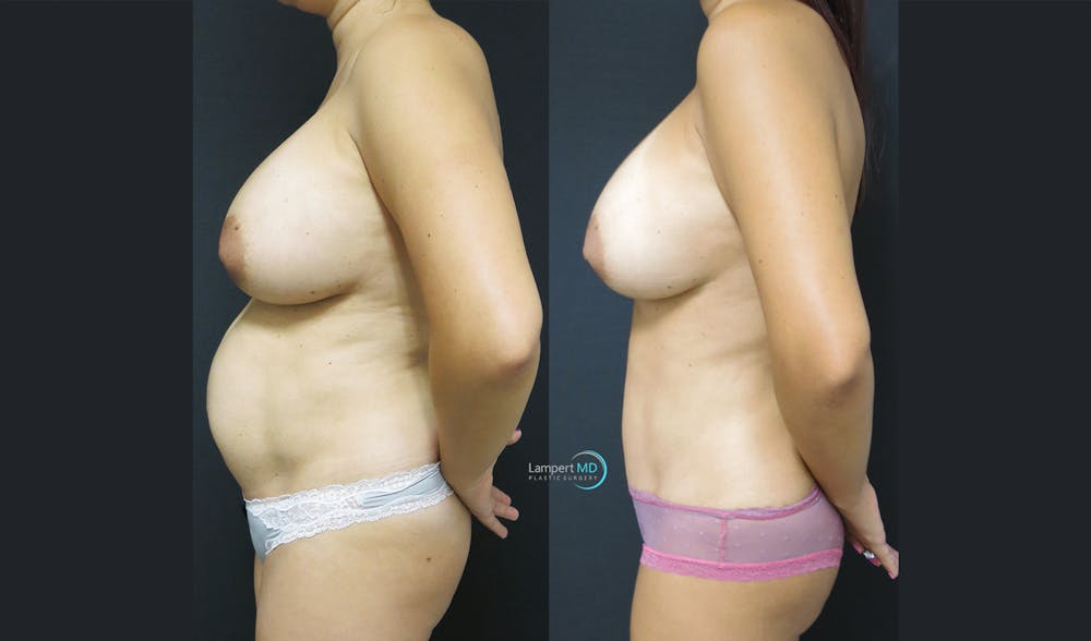 Tummy Tuck Before & After Gallery - Patient 122909158 - Image 4
