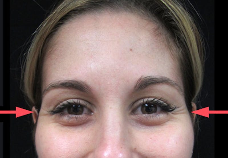 Botox Before & After Gallery - Patient 122909155 - Image 1