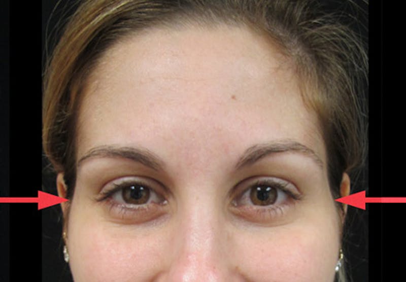 Botox Before & After Gallery - Patient 122909155 - Image 2