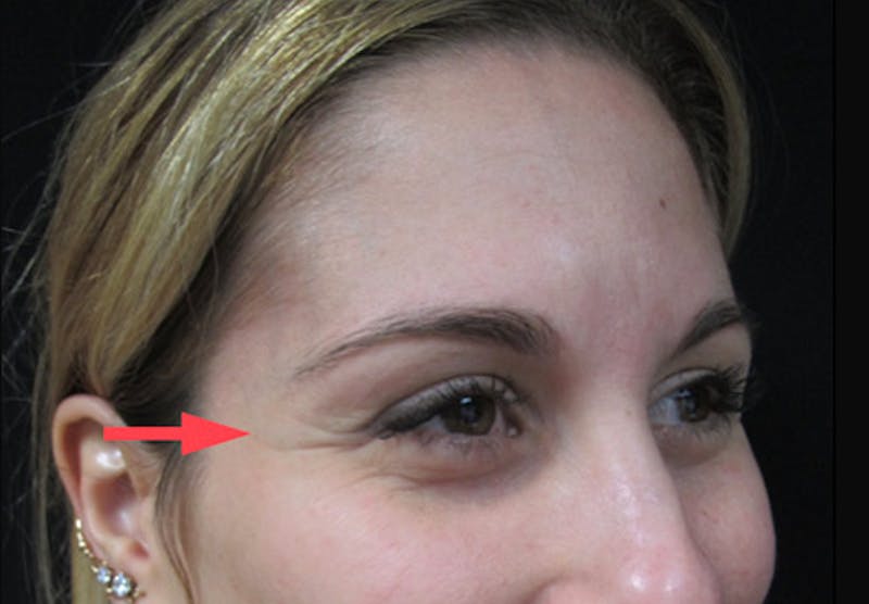 Botox Before & After Gallery - Patient 122909155 - Image 3