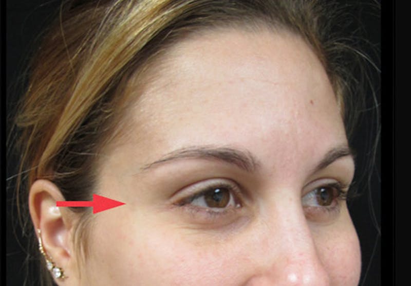 Botox Before & After Gallery - Patient 122909155 - Image 4