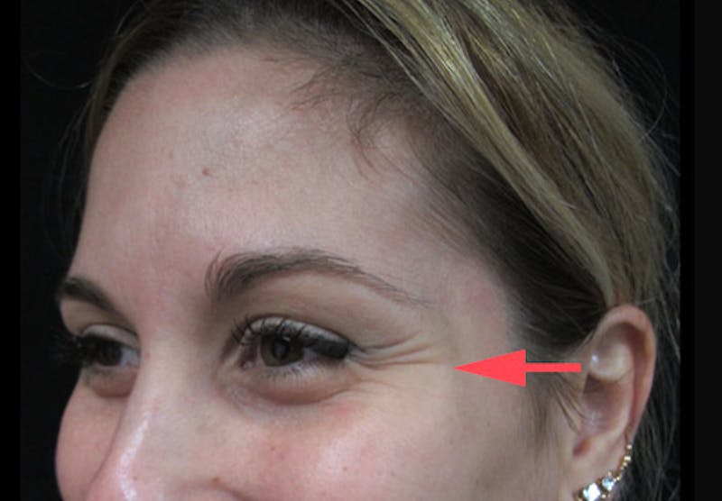 Botox Before & After Gallery - Patient 122909155 - Image 5