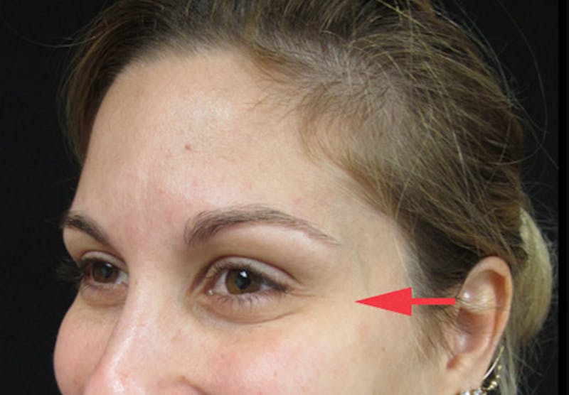 Botox Before & After Gallery - Patient 122909155 - Image 6