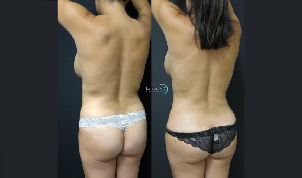 Tummy Tuck Before & After Gallery - Patient 122909158 - Image 6