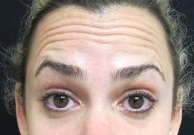 Botox Before & After Gallery - Patient 122909160 - Image 1