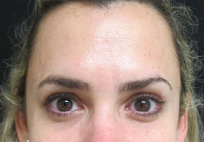 Botox Before & After Gallery - Patient 122909160 - Image 2