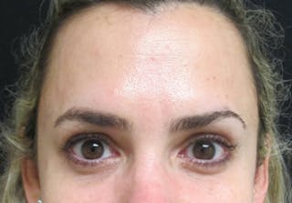 Botox Before & After Gallery - Patient 122909160 - Image 2