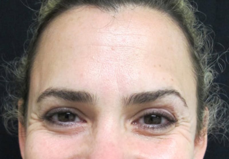 Botox Before & After Gallery - Patient 122909160 - Image 3