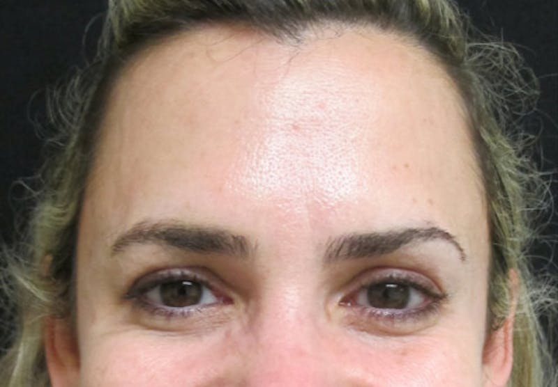 Botox Before & After Gallery - Patient 122909160 - Image 4