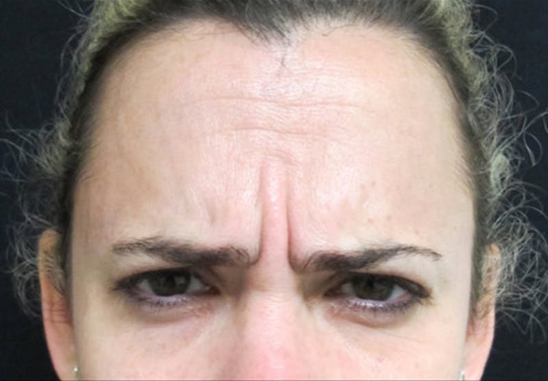 Botox Before & After Gallery - Patient 122909160 - Image 5