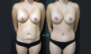 Tummy Tuck Before & After Gallery - Patient 122909164 - Image 1