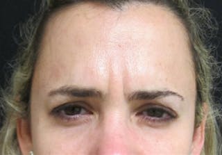 Botox Before & After Gallery - Patient 122909160 - Image 6