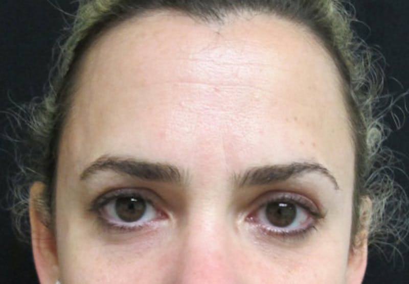 Botox Before & After Gallery - Patient 122909160 - Image 7