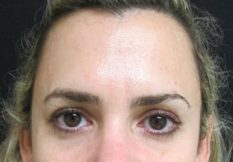 Botox Before & After Gallery - Patient 122909160 - Image 8