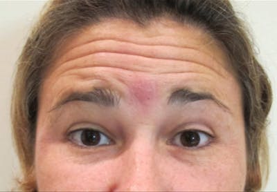 Botox Before & After Gallery - Patient 122909161 - Image 1