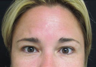 Botox Before & After Gallery - Patient 122909161 - Image 2