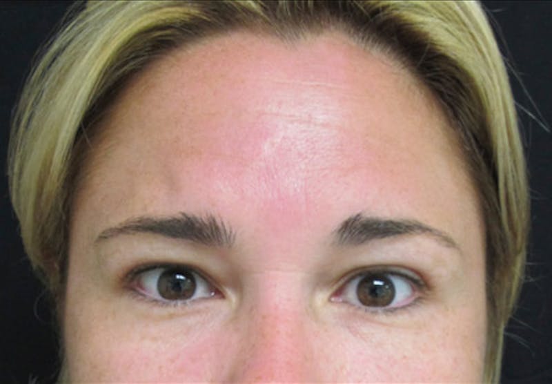 Botox Before & After Gallery - Patient 122909161 - Image 2