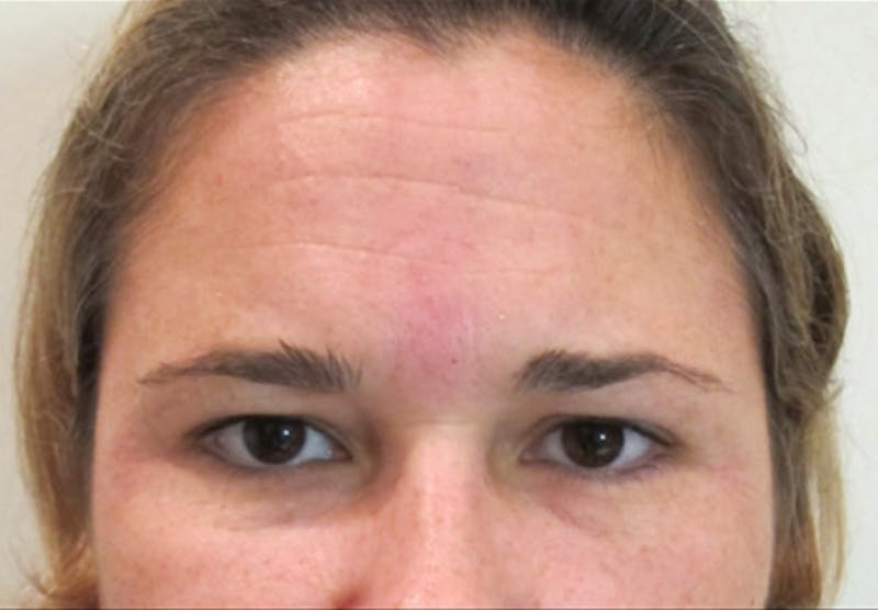 Botox Before & After Gallery - Patient 122909161 - Image 3