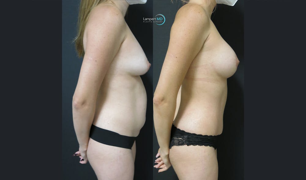 Tummy Tuck Before & After Gallery - Patient 122909164 - Image 3
