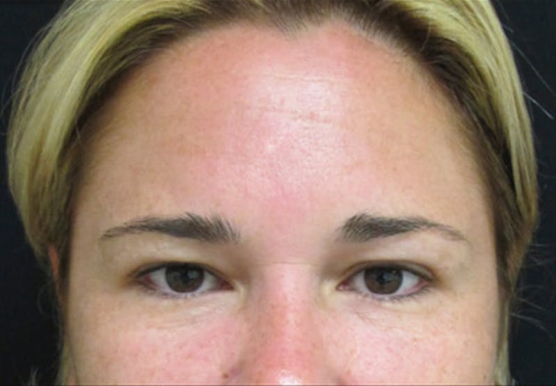 Botox Before & After Gallery - Patient 122909161 - Image 4