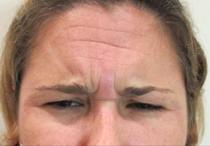 Botox Before & After Gallery - Patient 122909161 - Image 5