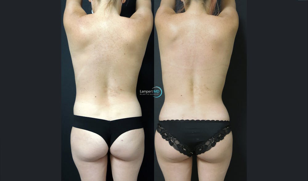 Tummy Tuck Before & After Gallery - Patient 122909164 - Image 4