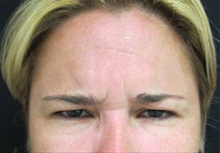 Botox Before & After Gallery - Patient 122909161 - Image 6