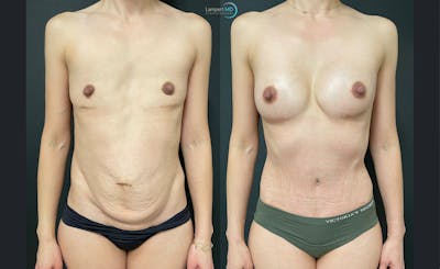 Tummy Tuck Before & After Gallery - Patient 122909172 - Image 1