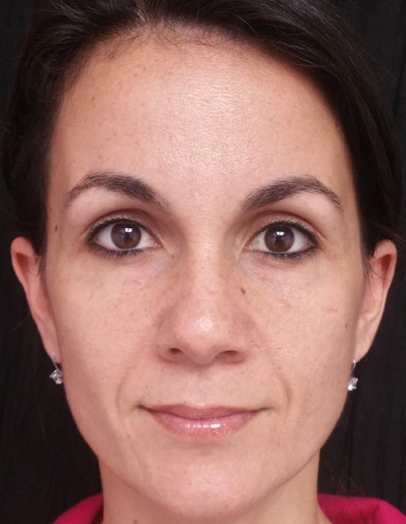 Botox Before & After Gallery - Patient 122909170 - Image 12