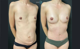 Tummy Tuck Before & After Gallery - Patient 122909172 - Image 2