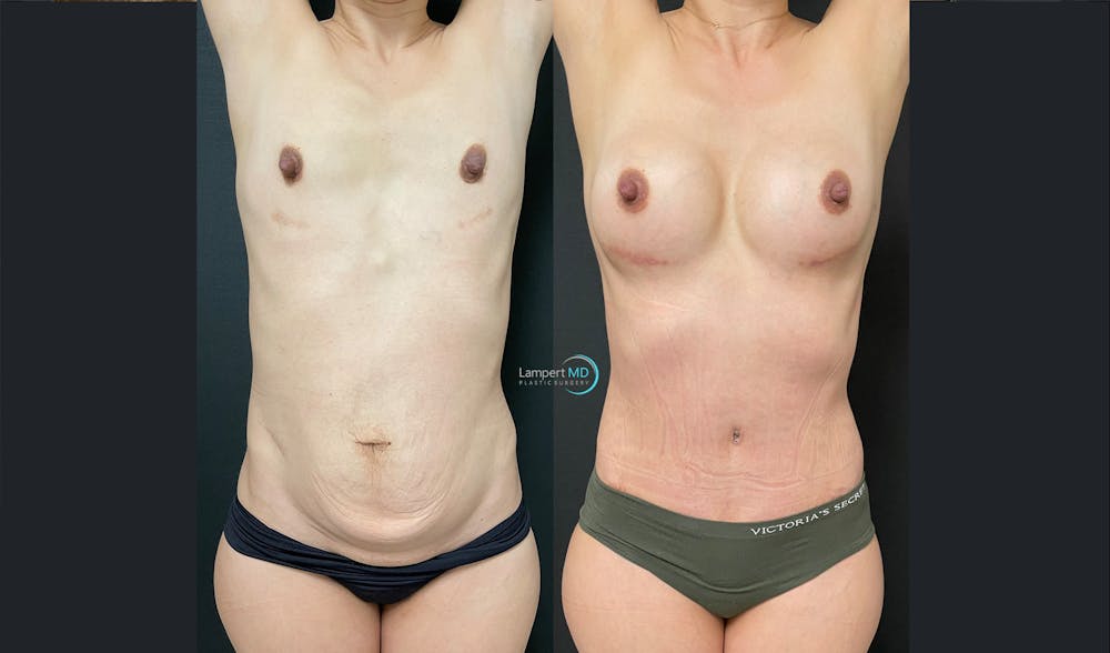 Tummy Tuck Before & After Gallery - Patient 122909172 - Image 4