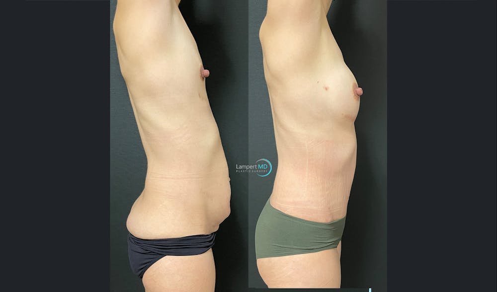 Tummy Tuck Before & After Gallery - Patient 122909172 - Image 5