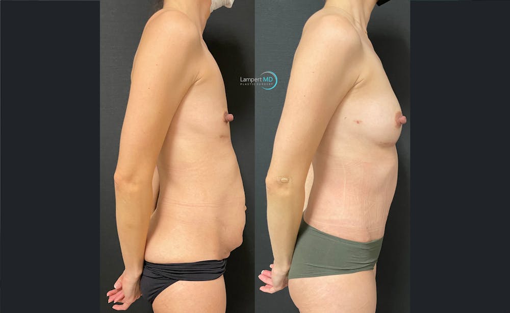 Tummy Tuck Before & After Gallery - Patient 122909172 - Image 6