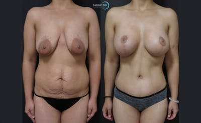 Tummy Tuck Before & After Gallery - Patient 122909179 - Image 1