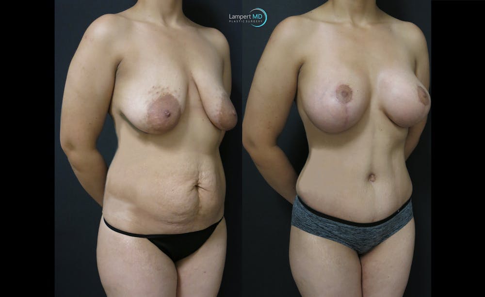 Tummy Tuck Before & After Gallery - Patient 122909179 - Image 2